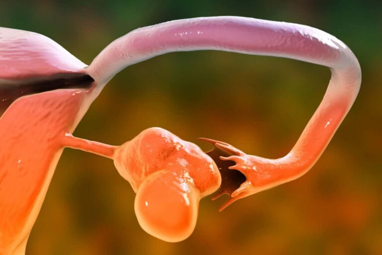 Polycystic ovary syndrome may be passed on via chemical tags on DNA