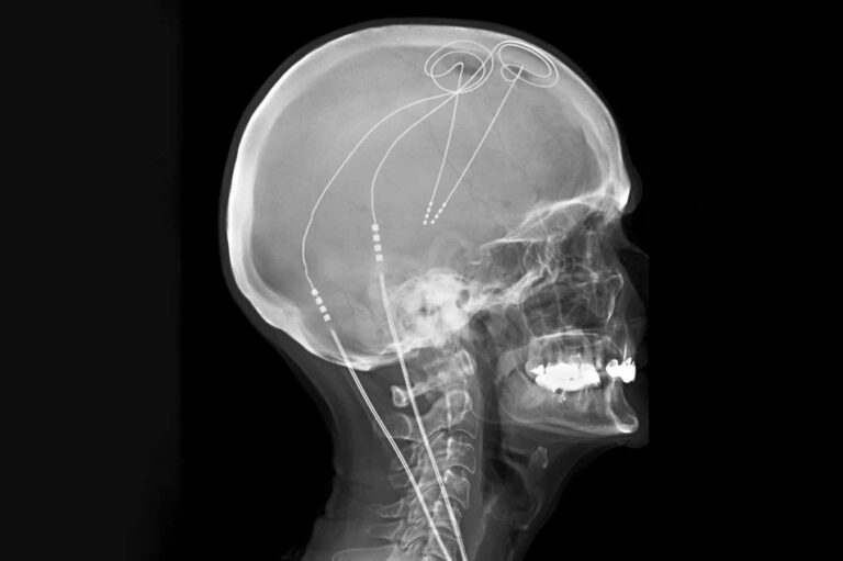 Bespoke brain implant gives long-term relief from chronic pain