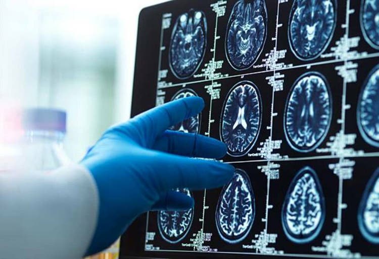 FDA recommends increased monitoring of Alzheimer’s patients on Leqembi