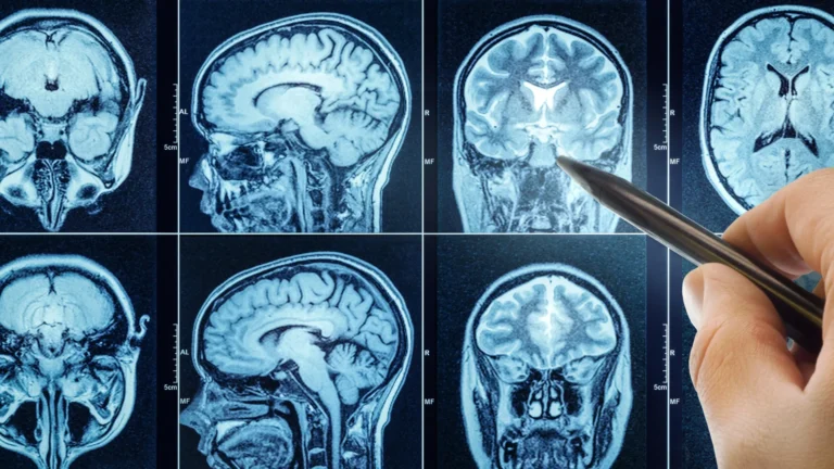 Poor sleep speeds brain aging and may raise dementia risk