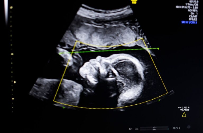 BioticsAI, which won Disrupt’s Battlefield competition in 2023, gains FDA approval for its AI-powered fetal ultrasound product 