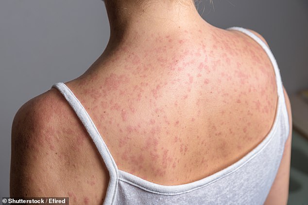 Measles outbreak hits schools and nurseries in north London with more than 60 children infected