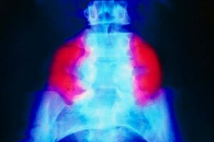 Stem cell patch reverses brain damage in fetuses with spina bifida