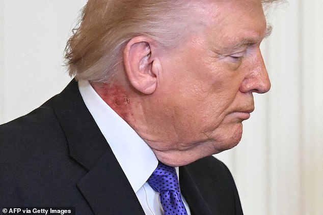 Trump sparks new health fears as viewers spot ‘nasty’ issue on his NECK