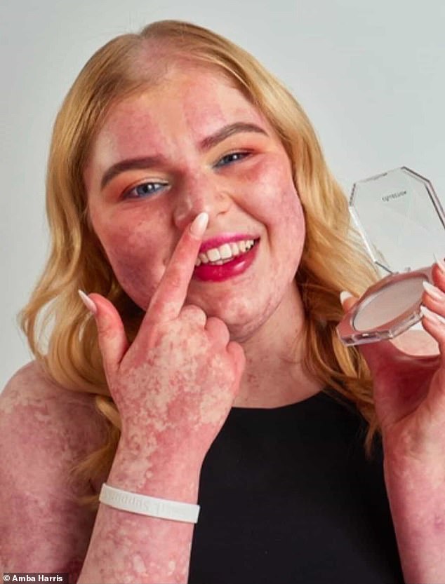 Woman with birthmarks on her face was ‘asked by Boots employee whether she was dressing up as a burns victim for Halloween party’