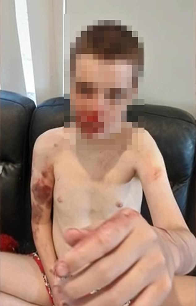 Disturbing photos emerge after Aussie discovers her son bruised and bloodied in an NDIS-supported home in Western Australia