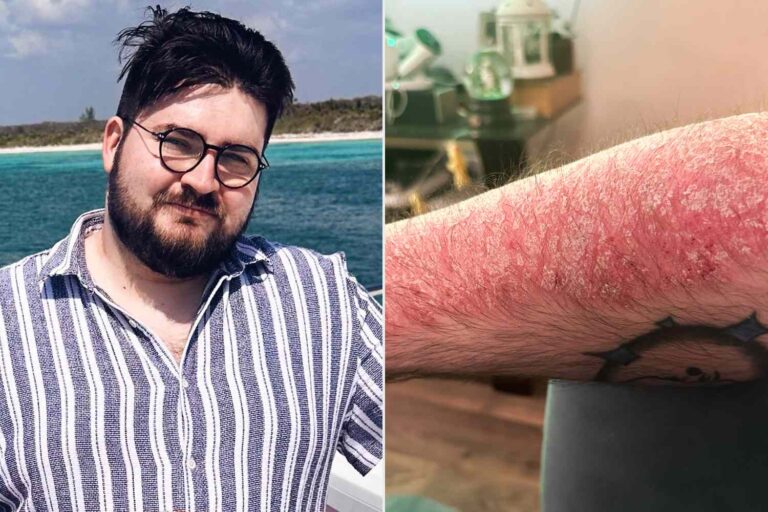 Man Recalls 'Emotional Toll' of Having Psoriasis as a Teen: 'It Was Very Difficult to Live and Be Out in the World' (Exclusive)