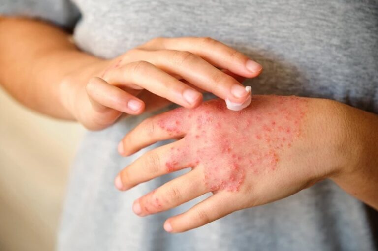 How stress causes an eczema flare up