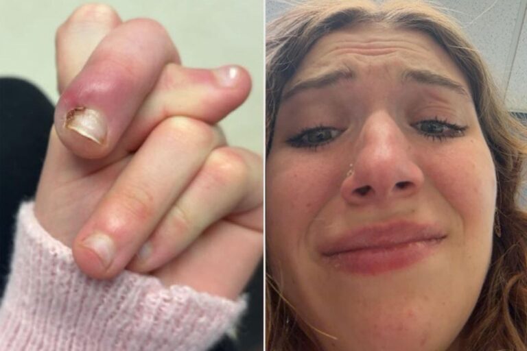 Woman, 21, Nearly Loses Her Finger After Childhood Nail-Biting Habit Leads to Severe Infection (Exclusive)