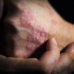 Why your psoriasis flares up in the same spots