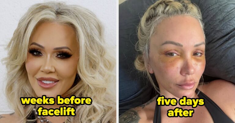 Celebrities Before And After Facelifts