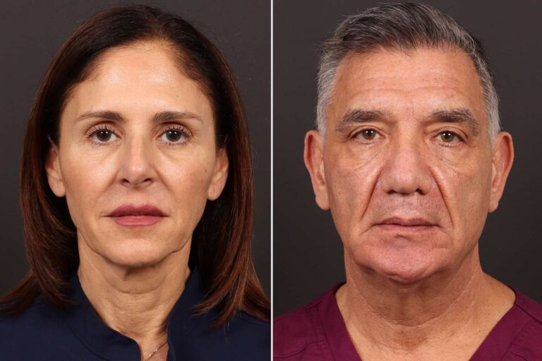 This Couple Got Matching Facelifts After Man Saw His Wife's Youthful Results