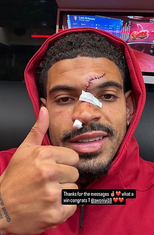 Morgan Gibbs-White shows off result of his horror head injury during Nottingham Forest’s win at Chelsea – just days before Europa League semi-final second leg against Aston Villa