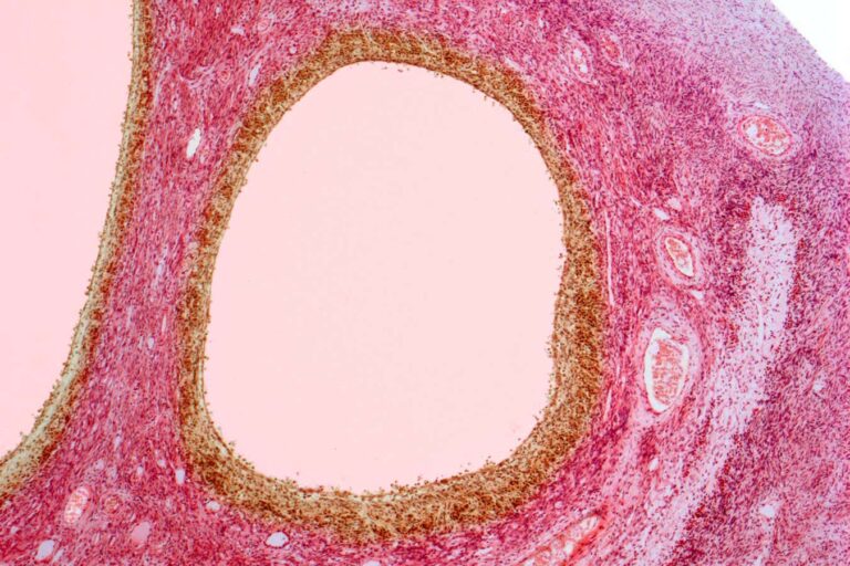PCOS has been officially renamed PMOS, and it’s a momentous move