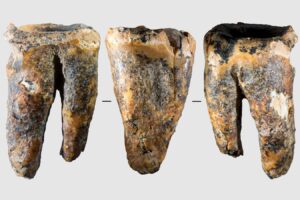Neanderthals treated a dental cavity by drilling into the tooth
