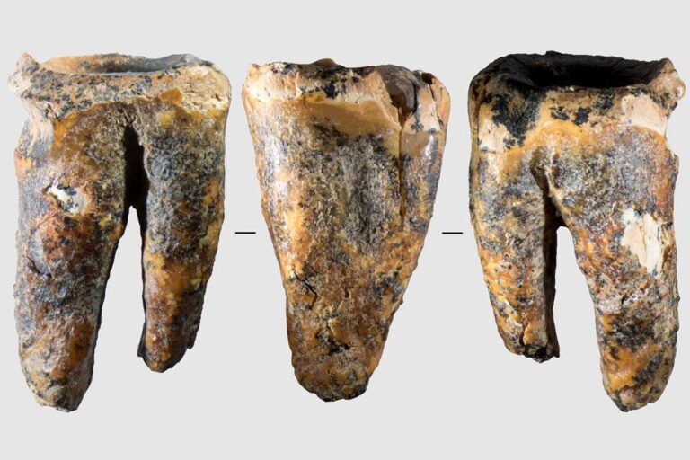 Neanderthals treated a dental cavity by drilling into the tooth