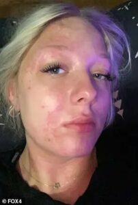 Small Texas town rocked by water crisis after teen girl is hospitalized with chemical burns from showering