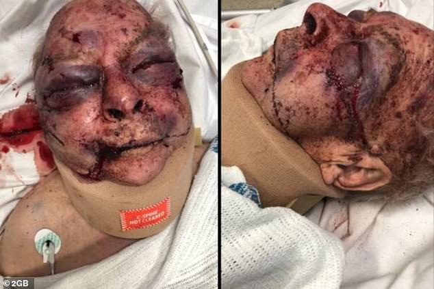 Sydney nursing home resident charged with assault after elderly man hospitalised with severe head injuries