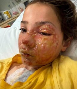 Father’s urgent warning after his daughter, 10, suffered horrific burns to her face from viral squishy toy trend popular on TikTok