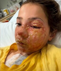 Dad cops nasty backlash after his daughter, 10, suffered horrific burns to her face when her viral squishy toy exploded
