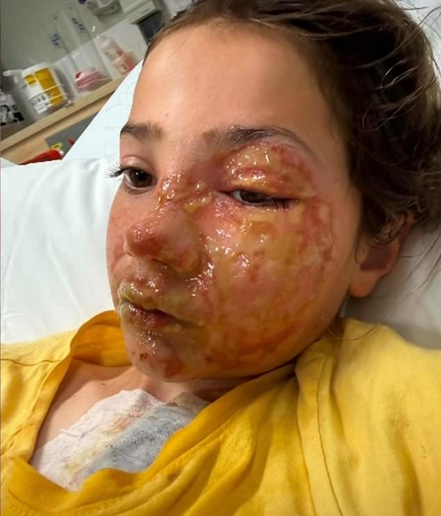 Dad cops nasty backlash after his daughter, 10, suffered horrific burns to her face when her viral squishy toy exploded