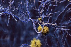 Huge study of Alzheimer’s genetics identifies new drug targets