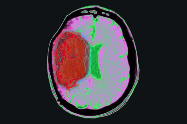 Chilling the body with drugs could limit brain damage from stroke