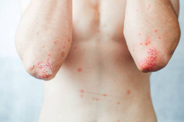 AbbVie’s Skyrizi gains pediatric psoriatic disease indication