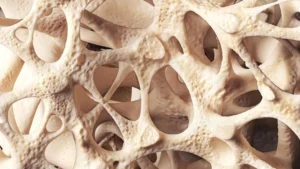 Osteopenia is silently weakening bones in millions of people