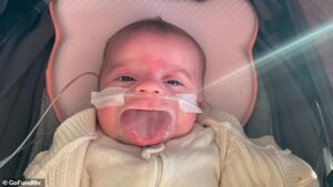 Baby Lulu’s brave battle as rare genetic disorder causes tongue to grow to an enormous size – as family’s world is turned upside down