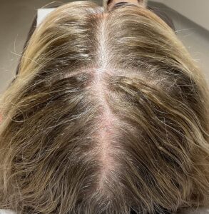 I was so ashamed of my thinning menopausal hair that I wore a hair piece and spent £60,000 trying to cure my bald spots. This is what finally worked (and it wasn’t any serum or transplant!) KATIE BRINDLE