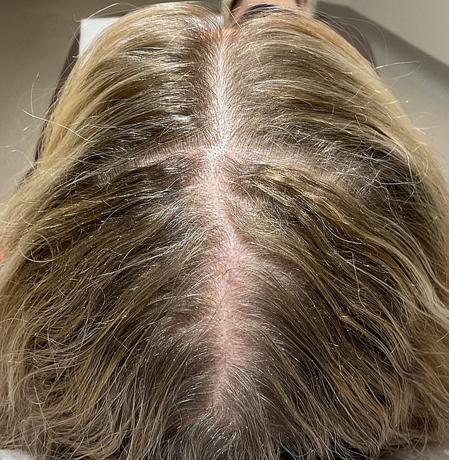 I was so ashamed of my thinning menopausal hair that I wore a hair piece and spent £60,000 trying to cure my bald spots. This is what finally worked (and it wasn’t any serum or transplant!) KATIE BRINDLE