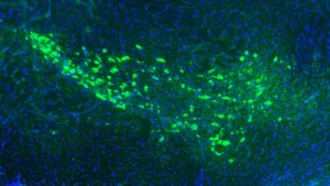 Yale scientists may have found how Parkinson’s disease spreads through the brain