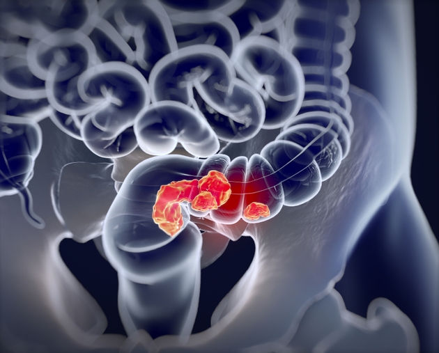 GSK’s Jemperli hits goal in phase 2 trial for rectal cancer (GSK:NYSE)
