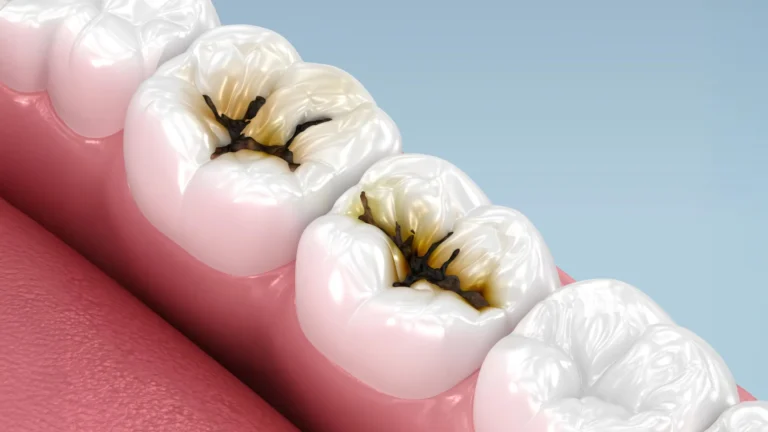 Scientists find a simple way to stop cavities without drilling