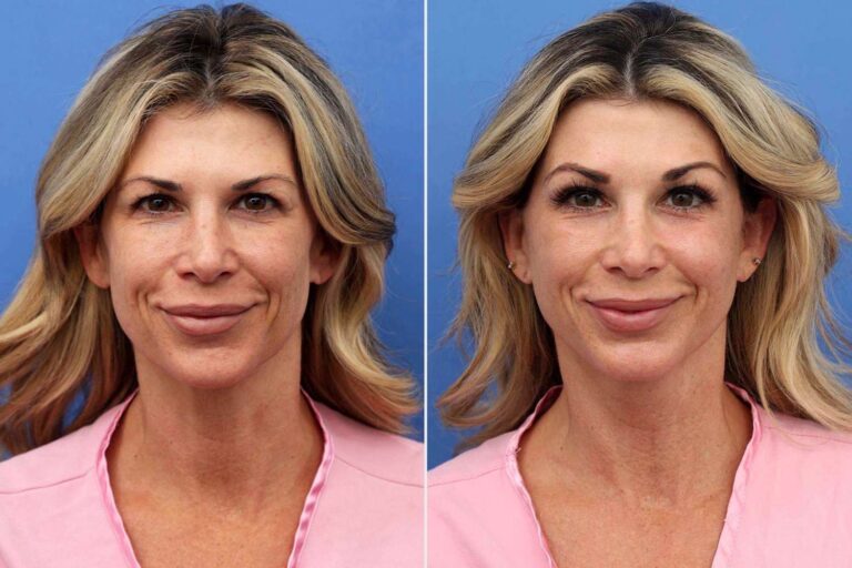 “Real Housewives” Star Alexis Bellino Is Already Celebrating Her 50th Birthday. She Bought Herself a Facelift (Exclusive)
